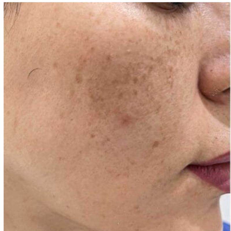 Pigmentation - Before