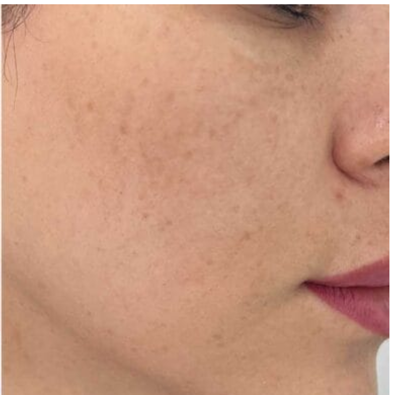 Pigmentation - After