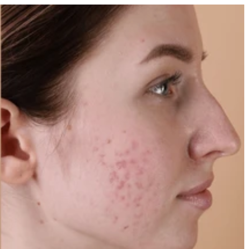 Acne - Before