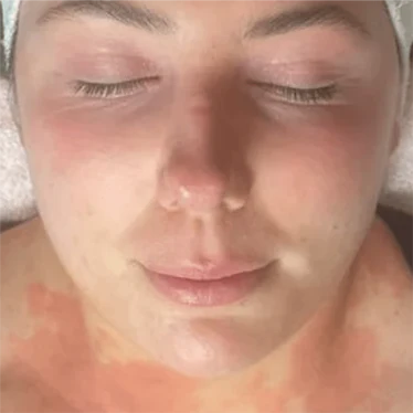 Inflammation - After